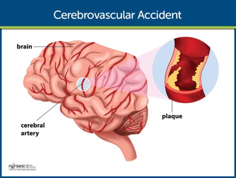 Cerebrovascular Accident (Stroke) Nursing Care and Management: A Study ...