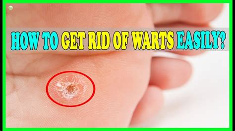 Common Warts On Feet / Pedicure tools ulta, home remedies for plantar warts on ... - Common ...