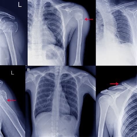 Shoulder Partial (Subluxation) or Full Dislocation Physiotheraphy