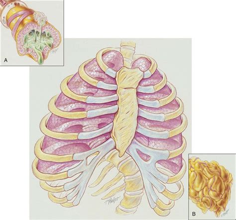 Kyphoscoliosis | Clinical Gate