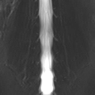 Image of T2-weighted MRI myelography of large Tarlov cysts on nerve ...