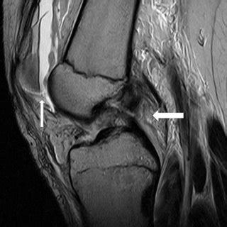 Coronal T1-weighted MRI image shows Segond fracture (arrow) and... | Download Scientific Diagram