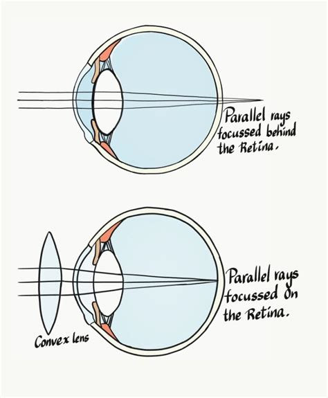 A Complete Overview of Hypermetropia (Farsightedness) - Medrenaline