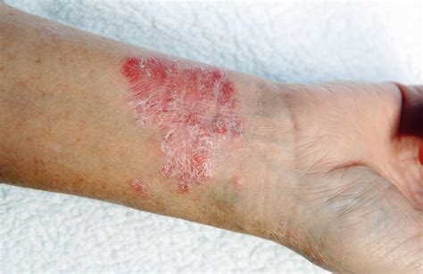 Psoriasis: Symptoms and Complications