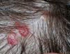 Red Bump on Scalp – Small Raised Painful, Itchy Scalp Bumps Causes & Treatment