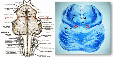 On the left side the ventral brainstem surface scheme with the...