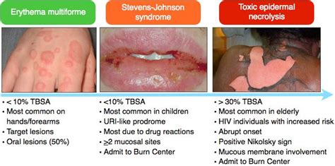 Rosh Review | Steven johnson syndrome, Dermatology, Nurse practitioner school