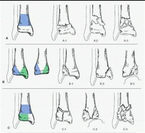 TIBIAL PILON FRACTURES CLASSIFICATION | Masaj