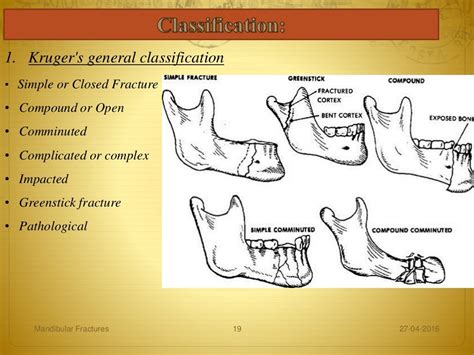 Mandibular fractures