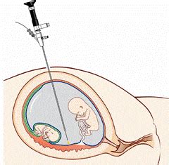 Fetoscopy