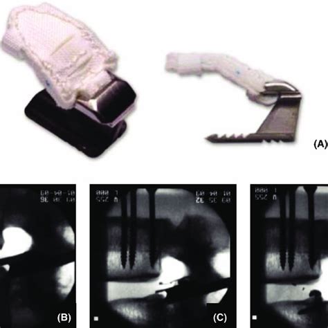 The Barricaid anular closure device (A) and its implantation through... | Download Scientific ...