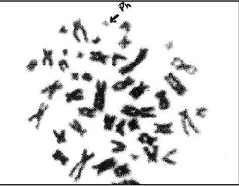 Metaphase spread of chromosomes in a male child with ALL showing... | Download Scientific Diagram