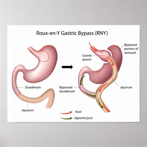 Roux-en-Y Gastric Bypass surgery poster | Zazzle.co.uk