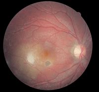 The Many Faces of Ocular Toxoplasmosis