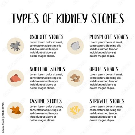 Types of kidneys stones. Oxalate, phosphate, xanthine, urate, cystine ...