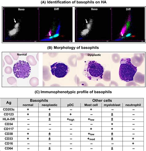 Basophilia Causes