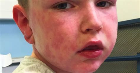 Boy, 7, allergic to winter breaks out in body rash and violently vomits ...