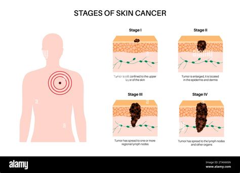 Malignant melanoma stages hi-res stock photography and images - Alamy