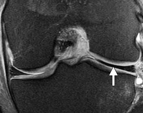 Understanding Meniscus: Importance, Diagnosis, and Management for Knee Health - Ashva