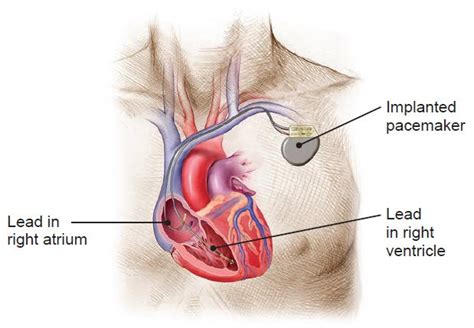 How pacemakers work - Boston Scientific