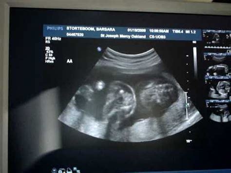 Twins-20 week ultrasound - YouTube