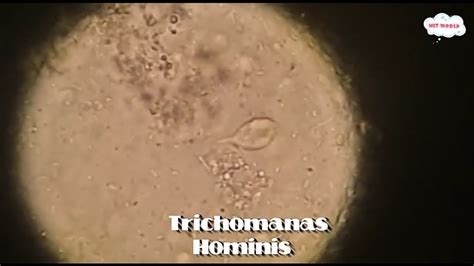 Trichomonas Hominis