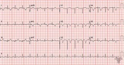 Wellens Syndrome | ECG Stampede