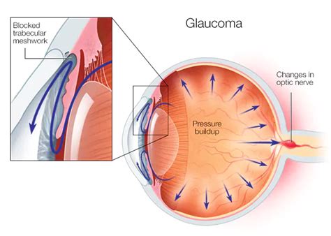 Primary Open Angle Glaucoma - Causes, Diagnosis, Treatment