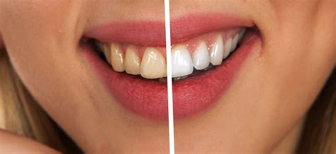 How Does a Tooth Polishing Procedure Work? - Medicalopedia