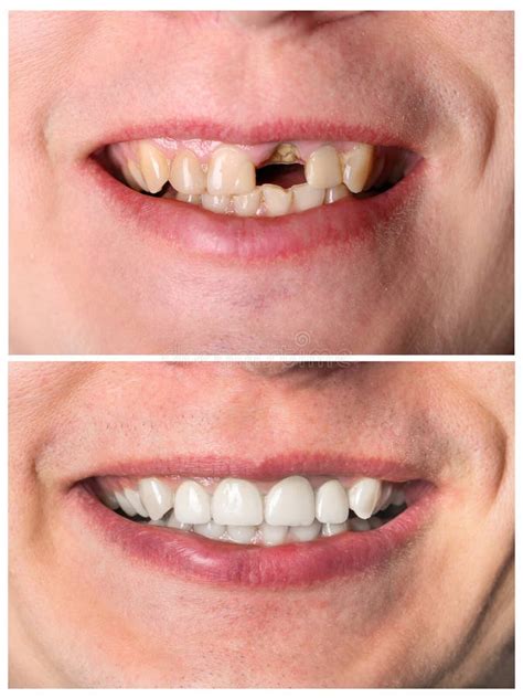 Restauração Incisivo Do Dente Antes E Depois Do Tratamento Foto de Stock - Imagem de patologia ...