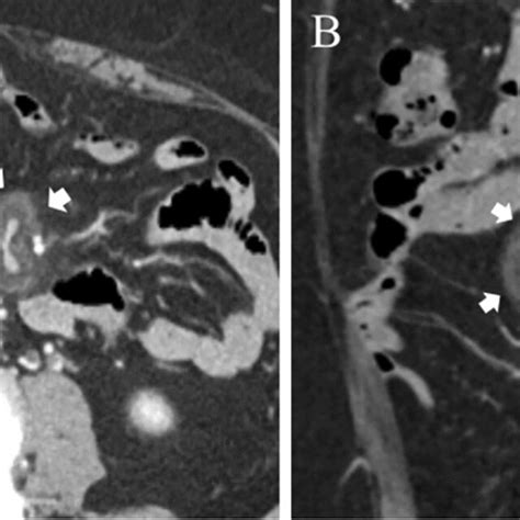 Imaging of sclerosing mesenteritis. Contrast-enhanced CT images (A ...