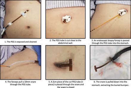 PWE-006 The T-piece pull technique removal of PEG buried bumpers – a quick novel endoscopic ...