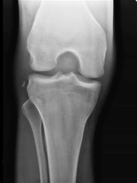 [Figure, Segond fracture Case courtesy of Dr Maulik S Patel ...