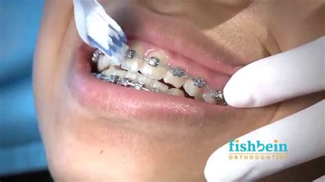 Orthodontic Home Care Instructions | Braces | Brushing - Dental Clinic