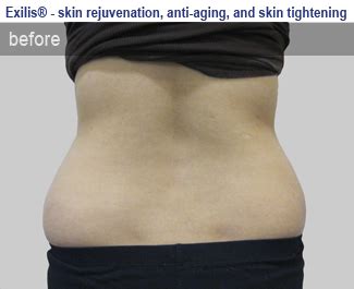 Exilis & Skin Tightening - Dermatology & Laser Institute of Colorado