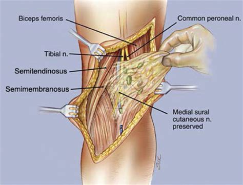 Enlarged Right Epitrochlear Lymph Node