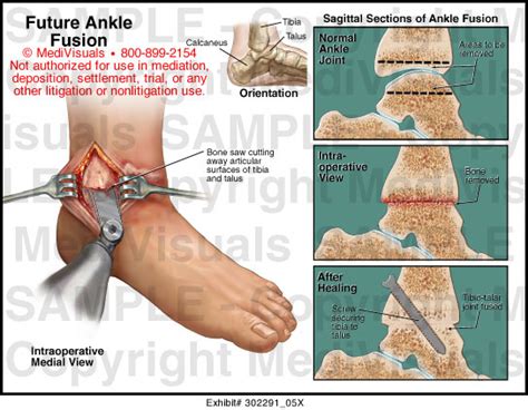 Future Ankle Fusion Medical Exhibit Medivisuals