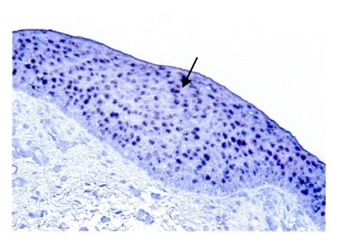 Mucin gene expression in laryngopharyngeal reflux mucosa. In situ ...