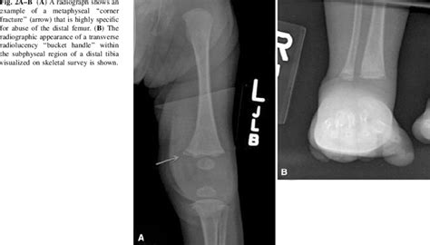 A–B (A) A radiograph shows an example of a metaphyseal ''corner... | Download Scientific Diagram