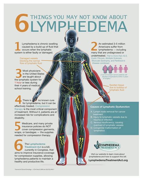 S'informer sur le lymphoedème: Les 3 stades du lymphoedème