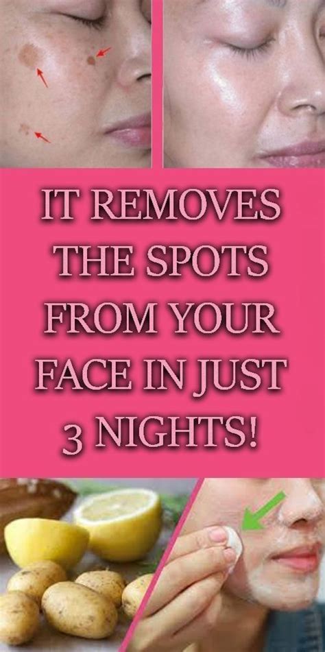 Natural Home Remedy To clear Your Skin Of Dark Spots Or Hyperpigmentation (With images) | Spots ...