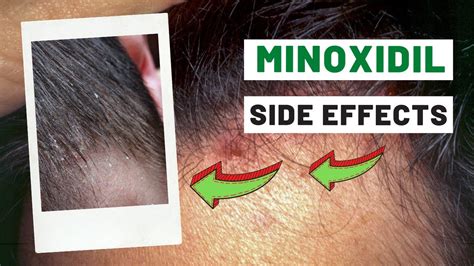 5 Common 'Side effects' of minoxidil | How to avoid the side effects ...