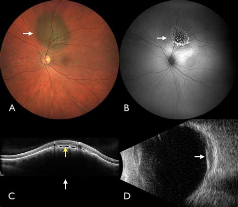 Multimodal imaging of malignant choroidal melanoma. (A) Choroidal ...