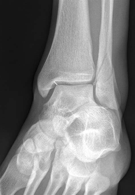 MRI of Isolated Distal Fibular Fractures with Widened Medial Clear Space on Stressed Radiographs ...