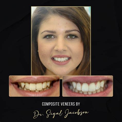 Composite Veneers Vs. Porcelain Veneers – Which is Better? | Jacobson Dental Group