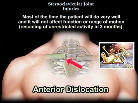 Sternoclavicular Joint Injuries - Everything You Need To Know - Dr. Nabil Ebraheim - YouTube