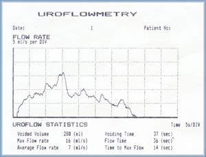 Uroflowmetry - used to detect the deficinecy in urinary tract by non-invasive method