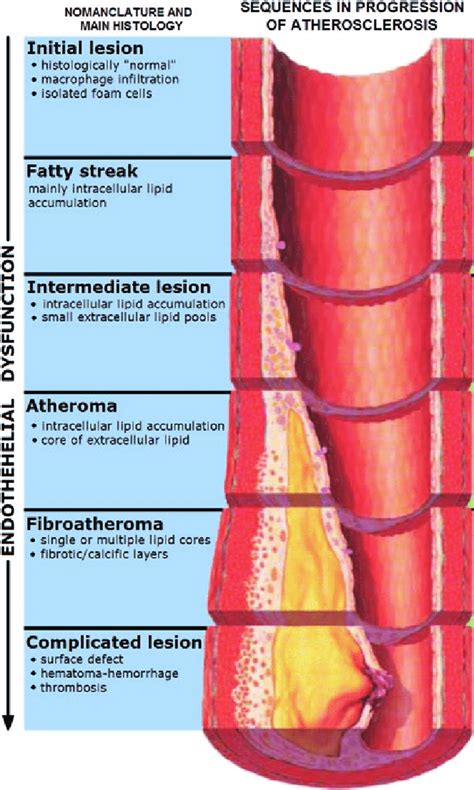 1 Pathophysiology of atheromatous plaque | Download Scientific Diagram