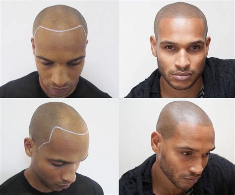 The Men Fighting Baldness By Tattooing Hair On Their Head