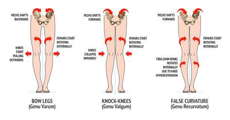 Image result for genu recurvatum | Genu valgum, Knock knees, Knock knees exercises